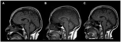 Anti-mGluR1 encephalitis: Case illustration and systematic review